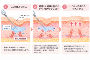 Three-panel medical illustration showing steps of CO2 gas therapy for skin scars: Step 1 CO2 gas injection into the skin with gas flowing into scar tissue and surrounding layers.
