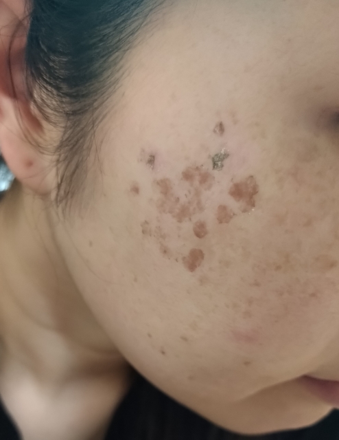 Close-up of a cheek showing multiple irregular brown pigmented spots and freckles on the skin surface.