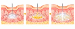 Three-panel diagram of a skin treatment: a device creates microchannels in the skin, then delivers yellow liposome-containing substance into the dermis, which diffuses outward.