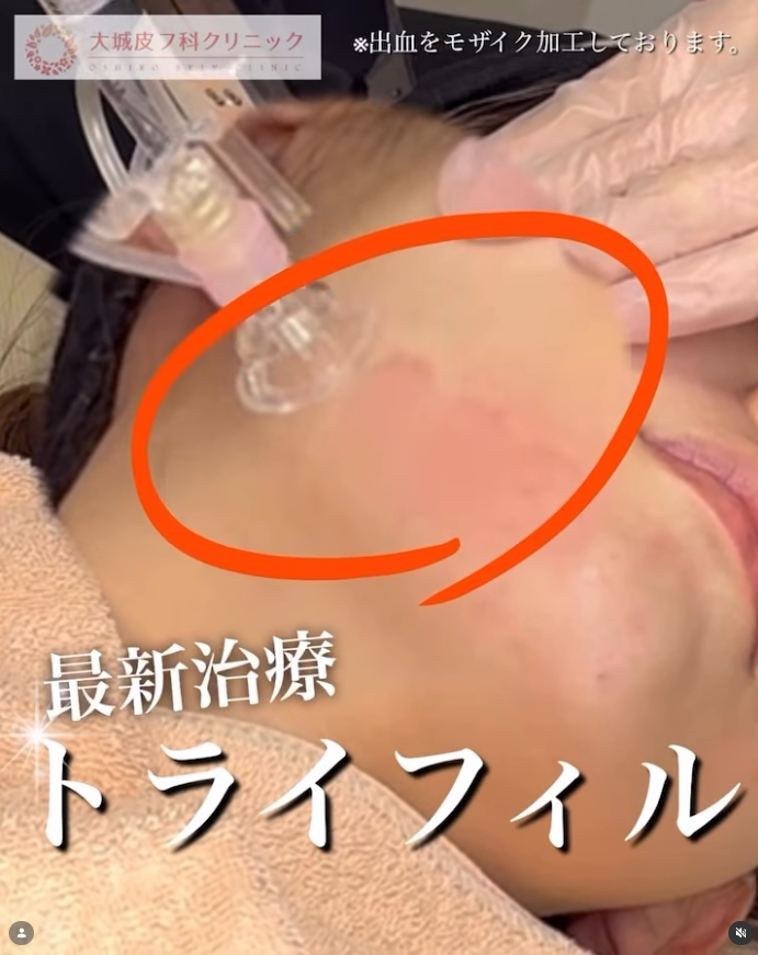 トライフィルプロの施術風景を紹介している公式Instagramへのリンク